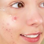 Acne-Prone Skin Nggak Kacau Lagi! Ini Rutinitas Simpel yang Ampuh