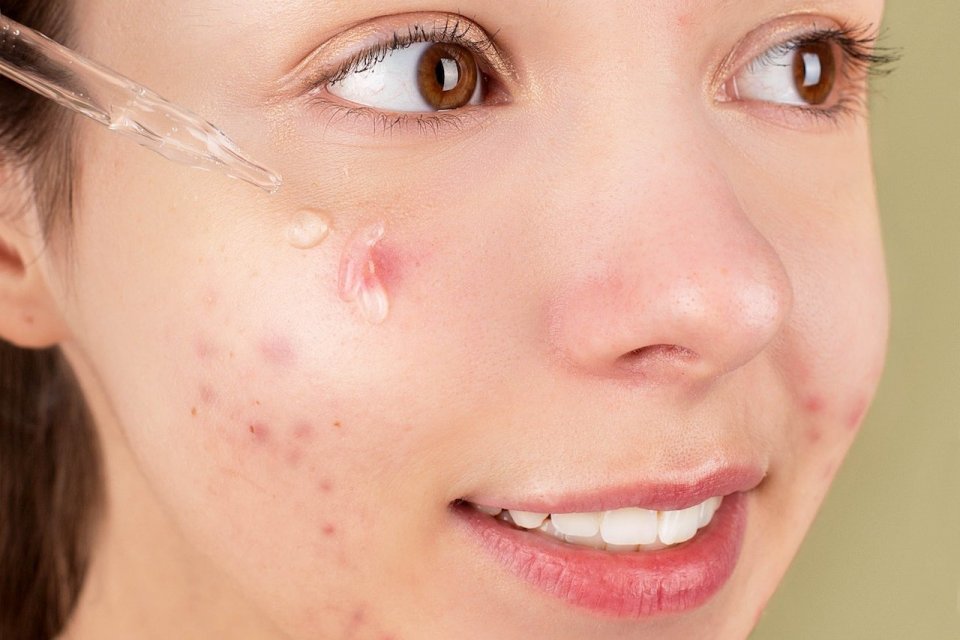 Acne-Prone Skin Nggak Kacau Lagi! Ini Rutinitas Simpel yang Ampuh