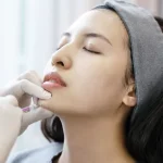 Rahasia Kulit Muda: 6 Suntik Filler yang Perlu Anda Coba