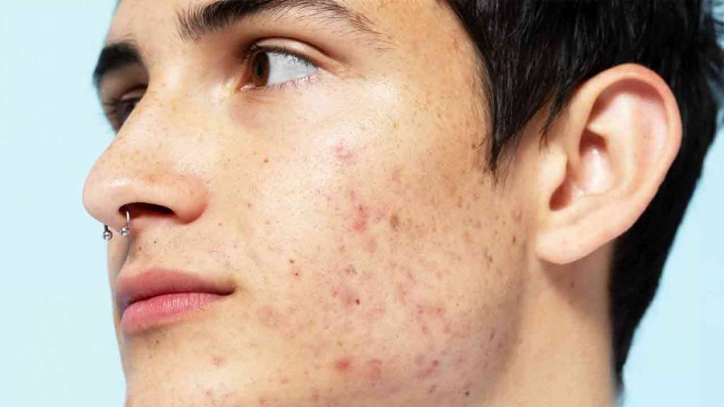 Tanpa Bahan Kimia! Ini 5 Tips Alami Mengatasi Bekas Jerawat Hitam