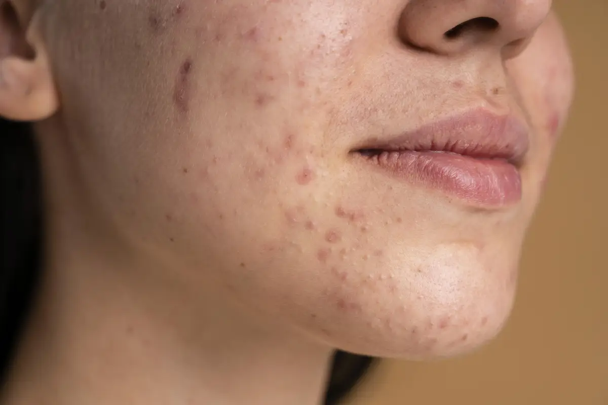 Kulit Sering Bermasalah? Mungkin Skin Barrier Kamu Rusak, Ini 7 Ciri Utamanya