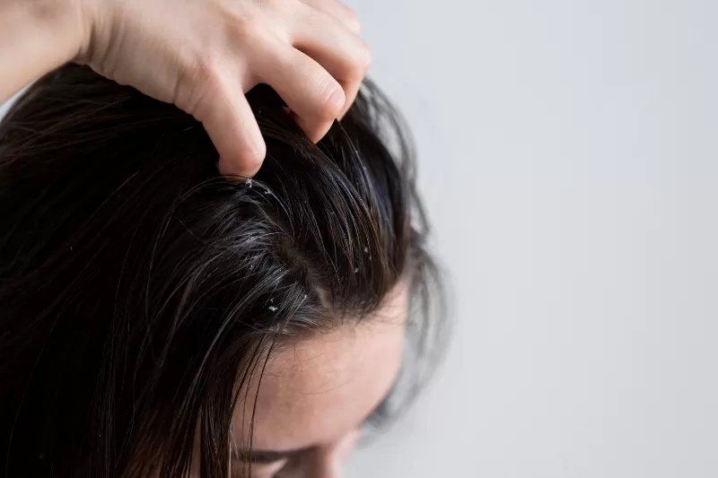 7 Cara Ampuh Atasi Rambut Berminyak: Solusi Praktis untuk Sehari-hari