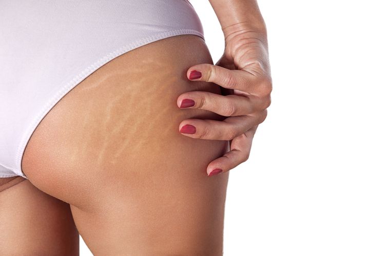 Stretch Mark Mengganggu? Ini Cara Efektif Menghilangkannya Secara Alami dan Medis