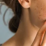 Kenapa Jerawat Sering Muncul di Pipi? Ini Penyebab dan Cara Mengatasinya