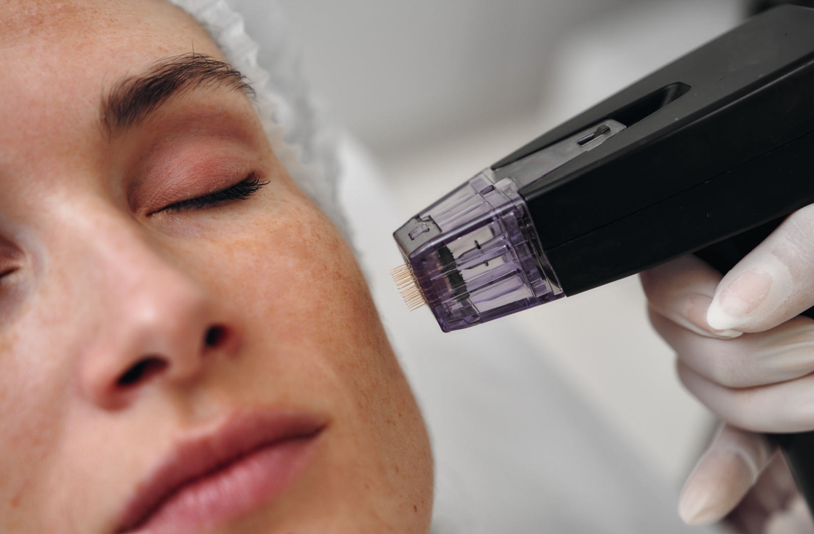 Microneedling: Teknik Peremajaan Kulit yang Semakin Populer, Apa Manfaatnya?