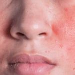 Waspadai 7 Tanda Skin Barrier Rusak: Dampaknya Bisa Bikin Kulit Semakin Parah!