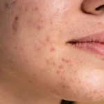 5 Cara Alami Hilangkan Bekas Jerawat Hitam, Ampuh dan Aman untuk Kulit!