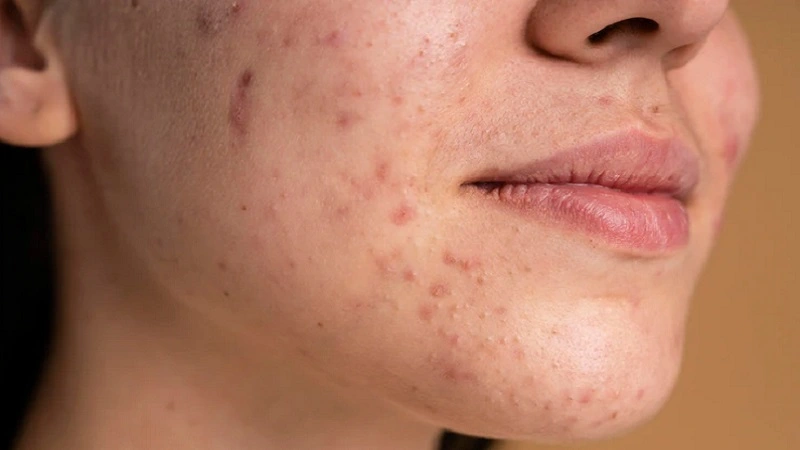 5 Cara Alami Hilangkan Bekas Jerawat Hitam, Ampuh dan Aman untuk Kulit!