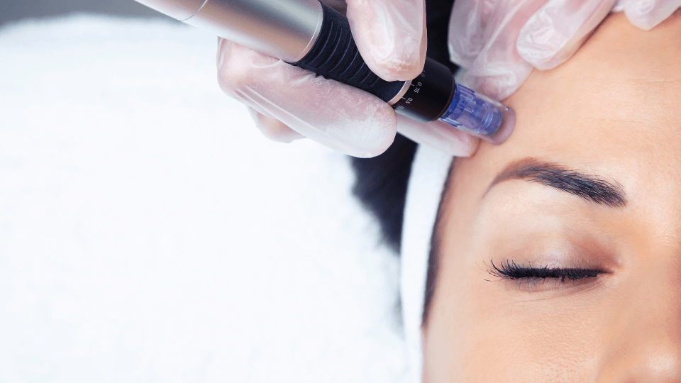 Punya Kulit Rentan Jerawat? Microbotox Bisa Jadi Perawatan Wajah yang Tepat!